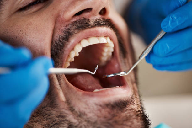 Best Chipped Tooth Repair Near Me  in Mineville, NY